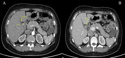 Primary gastrinoma of the gallbladder: a case report and review of the literature